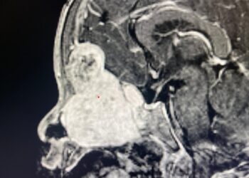 Complete Endoscopic Removal of 7 cm Skull Base Meningioma at PGIMER, Chandigarh